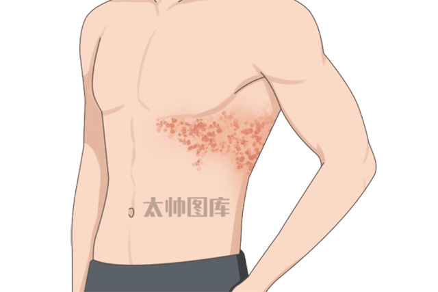 警惕“缠腰龙” | 科学应对，告别带状疱疹疼痛困扰